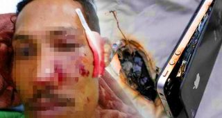 อุทาหรณ์!! หนุ่มมาเลเซียวัย 28 ปีเจ็บหนัก มือถือระเบิดใส่หน้า หลังกดรับสายขณะชาร์จแบตเตอรี่