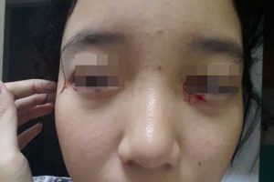แชร์สนั่น! หญิงสาวปิดไฟเล่นมือถือ ตาอักเสบเส้นเลือดในตาแตก จนน้ำตาไหลเป็นเลือด