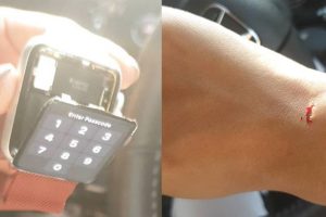 เตือนผู้ใช้!! Apple Watch ระวังแบตเตอรี่บวม ดันกระจกจอแตก จนบาดข้อมือ